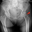 Osteoporoza to nie tylko choroba kobieca — podkreślają naukowcy