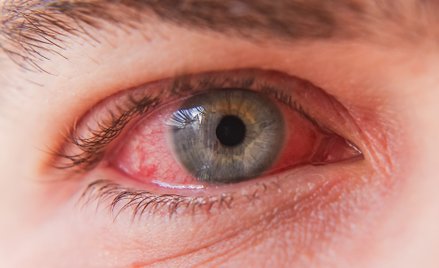 Najbardziej charakterystycznym objawem zapalenia spojówek jest zaczerwienienie oka