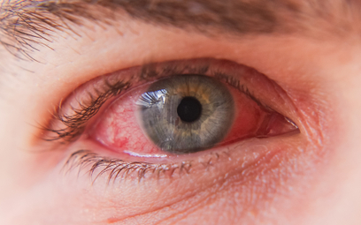 Najbardziej charakterystycznym objawem zapalenia spojówek jest zaczerwienienie oka
