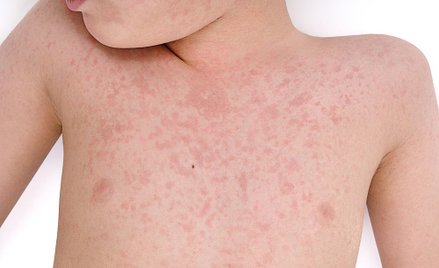 "Mamy epidemię raka, a panikujemy na myśl o odrze"
