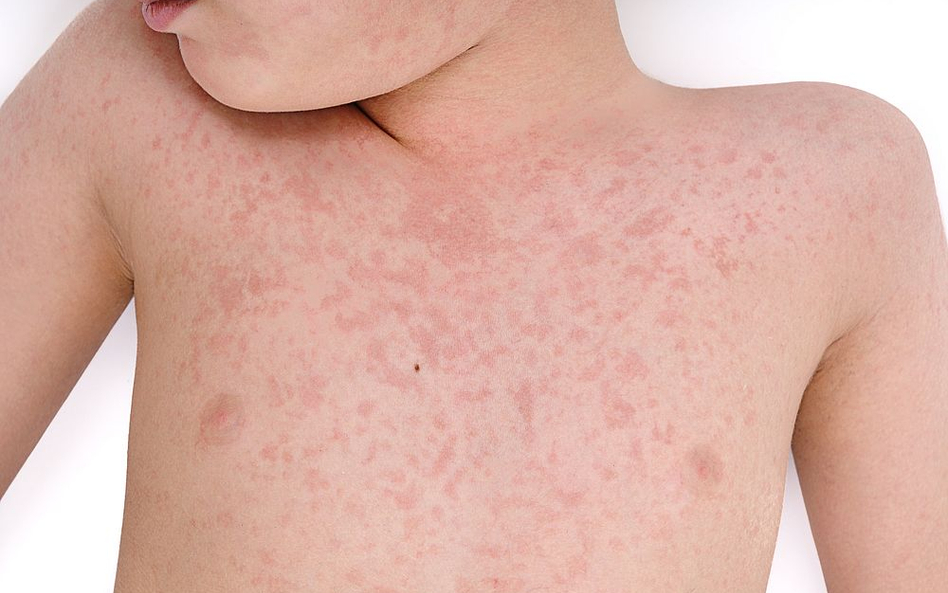 "Mamy epidemię raka, a panikujemy na myśl o odrze"