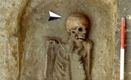 50-latek zamiast przedramienia miał protezę wykonaną z noża mat. pras.