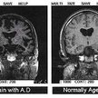 Mózg osoby chorej na chorobę Alzheimera i zdrowej osoby w podeszłym wieku