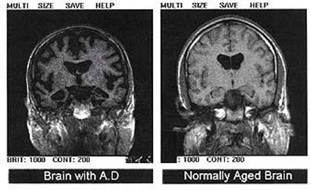 Mózg osoby chorej na chorobę Alzheimera i zdrowej osoby w podeszłym wieku