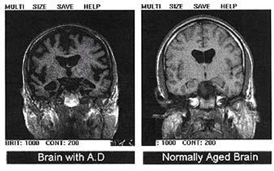 Mózg osoby chorej na chorobę Alzheimera i zdrowej osoby w podeszłym wieku