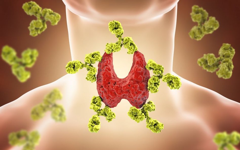 Choroby zapalne tarczycy należą do częstych schorzeń autoimmunologicznych, jakie atakują głównie kob