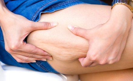 Jak zwalczyć cellulit? To zależy od jego przyczyny.