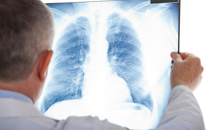 Koronawirus. USA: Ozdrowieniec "podarował" płuca choremu na COVID. Udało się