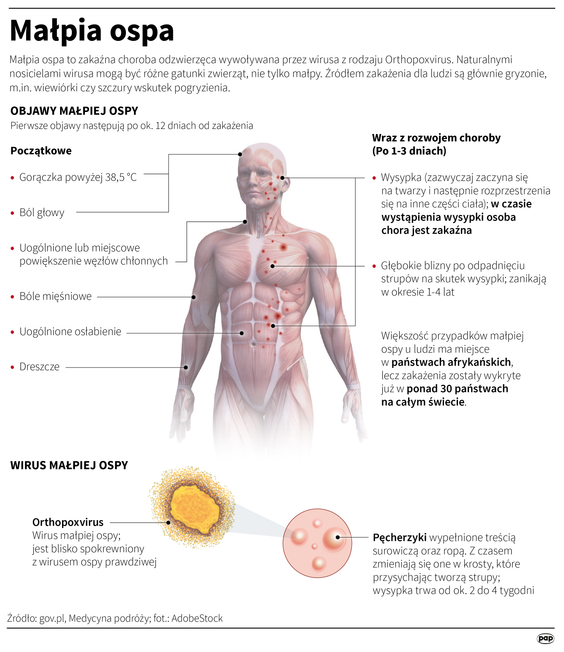 Wirus małpiej ospy i objawy zakażenia