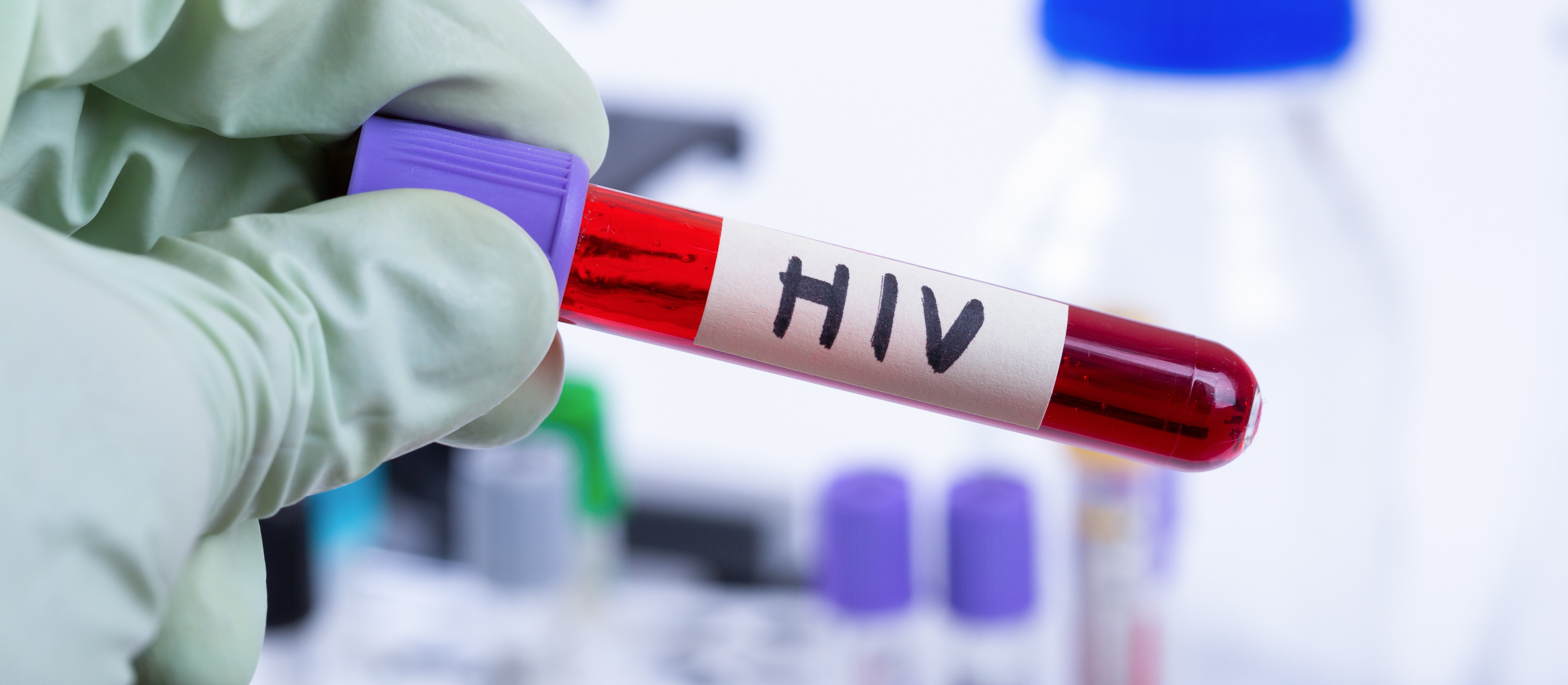 Epidemia HIV przyspieszyła ewolucję człowieka