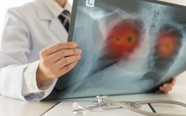 Jak zmienić niechlubne statystyki umieralności na nowotwory płuc?