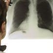 Ukraina: Oficjalnie 35 tys. pacjentów z gruźlicą. Nieoficjalnie 17 razy więcej