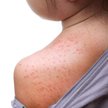 Nowozelandzka gazeta wyśmiewa wybuch epidemii odry na Samoa
