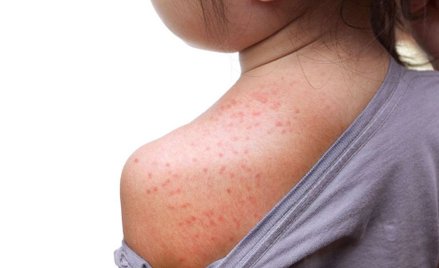 Nowozelandzka gazeta wyśmiewa wybuch epidemii odry na Samoa