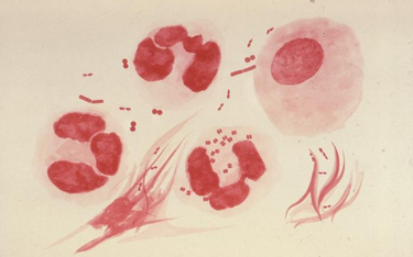 Chorobę wywołują bakterie tlenowe - dwoinki rzeżączki