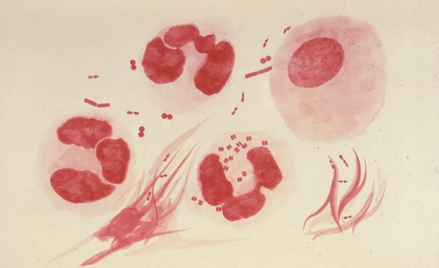 Chorobę wywołują bakterie tlenowe - dwoinki rzeżączki