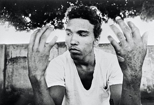 Młody mężczyzna pokazuje ręce skażone silnym promieniowaniem po incydencie radioaktywnym w Brazylii 