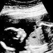 Belgia: Możliwa legalna aborcja do 18. tygodnia. Biskupi protestują