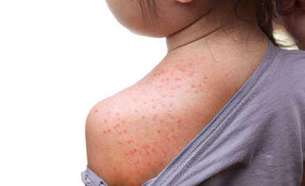 Epidemia odry na Samoa: Kolejne dzieci umierają