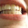 Zęby u dentysty