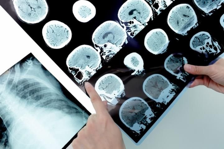 Szpital w Skarżysku-Kamiennej ogranicza leczenie chorych na SM