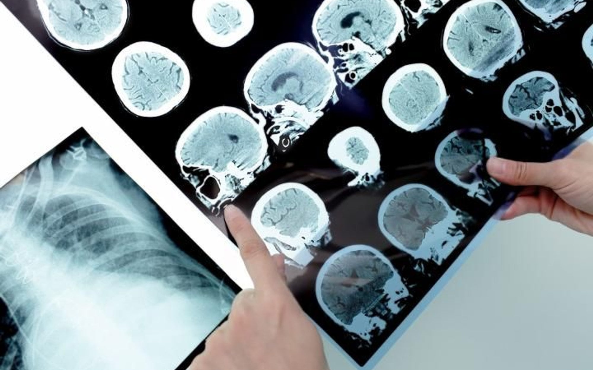 Szpital w Skarżysku-Kamiennej ogranicza leczenie chorych na SM