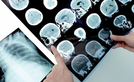 Szpital w Skarżysku-Kamiennej ogranicza leczenie chorych na SM