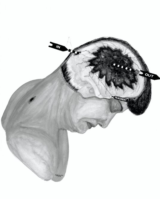 Średnica rany wlotowej wyniosła 6 mm. Kula przeleciała ok. 15 mm w głowie i eksplodowała, odrzucając