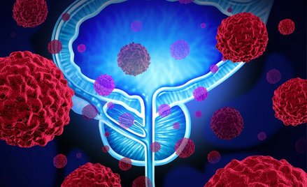 25 proc. nowotworów stanowią te urologiczne, w tym rak prostaty (na zdjęciu). Połowa 50-latków może 