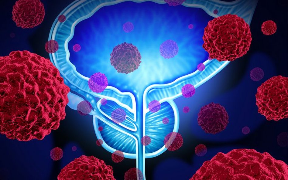 25 proc. nowotworów stanowią te urologiczne, w tym rak prostaty (na zdjęciu). Połowa 50-latków może 