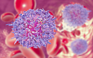 Przewlekła białaczka limfocytowa to najczęstszy nowotwór krwi.