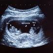 Informacja o tym, że Aborcyjny Dream Team pomógł w kolejnym kontrowersyjnym zabiegu: selektywnej abo