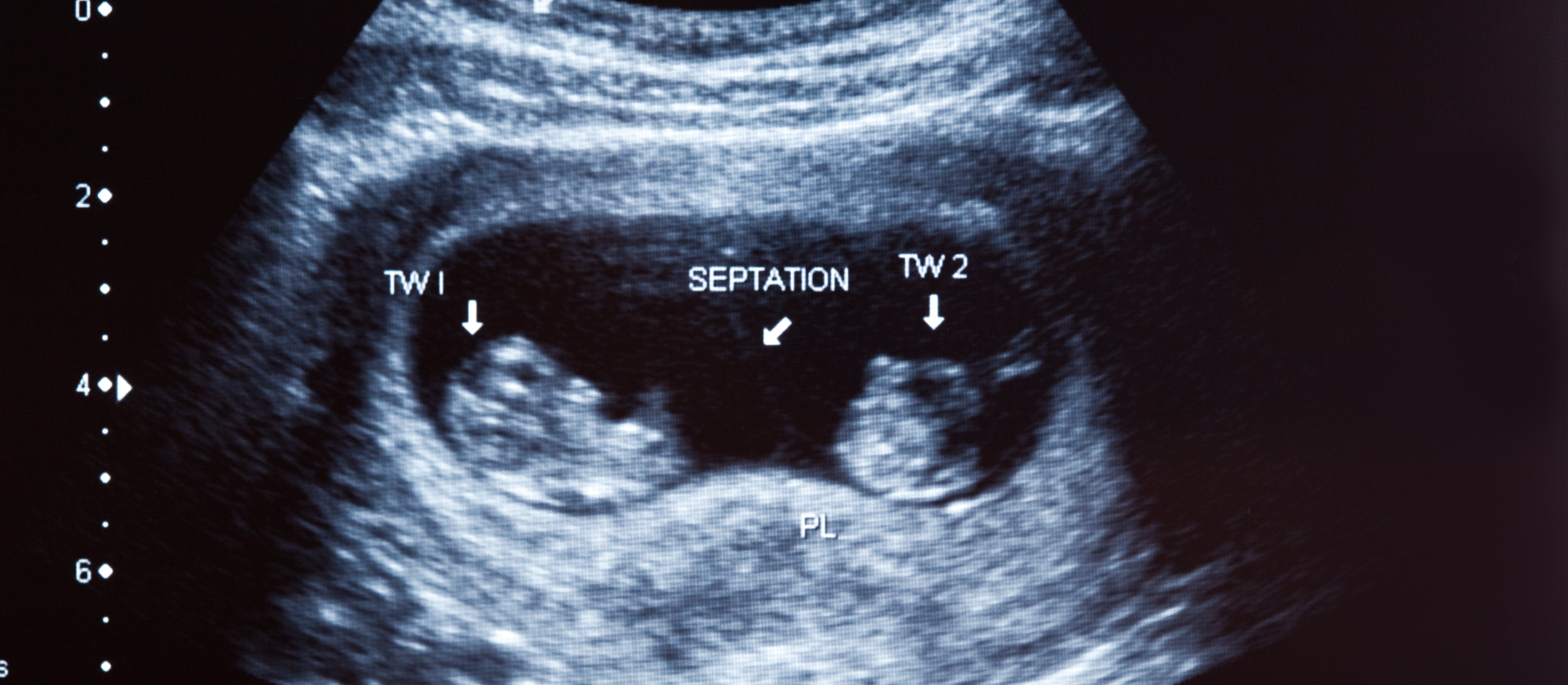 Kontrowersyjna aborcja z pomocą polskich aktywistek. Działacze pro‑life protestują