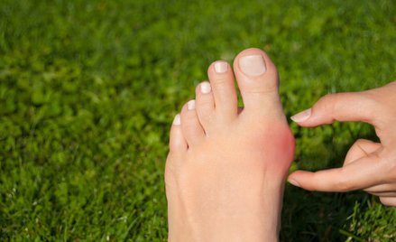 Halluksy: czy naprawdę można się ich pozbyć bez operacji?