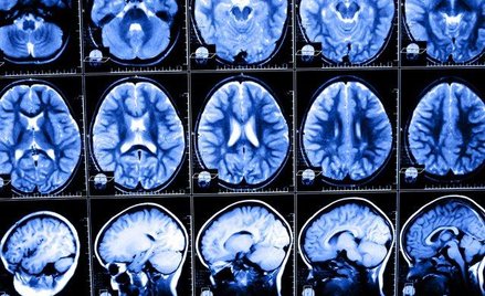 Depresję zdradza nietypowa aktywność mózgu.