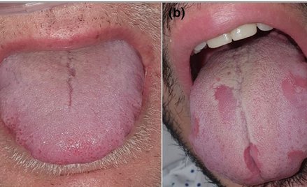 Hiszpańscy badacze: Zmiany na języku mogą świadczyć o COVID