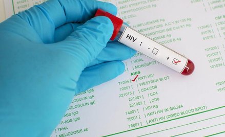 Często lekarze rozpoznają zakażenia HIV w późnym stadium choroby.