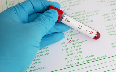 Często lekarze rozpoznają zakażenia HIV w późnym stadium choroby.