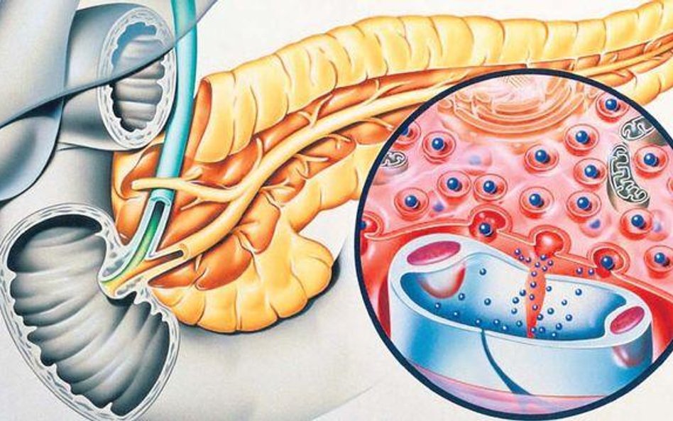 Cukrzyca typu 1 wiąże się z niszczeniem komórek beta trzustki (w kolorze czerwonym, żółta trzustka) 