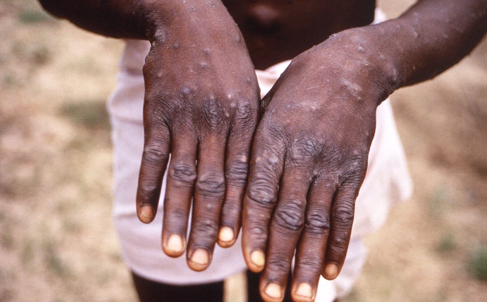 Nowy wariant wirusa mpox groźniejszy. Polska aktualizuje wytyczne