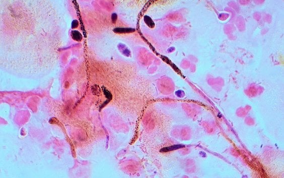 „Candida albicans" z wymazu z pochwy. Mikrofotografia o wysokiej rozdzielczości. Obraz przedstawia s