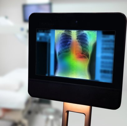 NHS testuje technologię, która skraca diagnozę raka płuca z tygodni do jednego badania