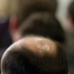 Zanim nowa terapia łysienia wejdzie do użytku minie pięć lat - zapowiadają naukowcy