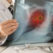 Rak płuca chorobą przewlekłą?