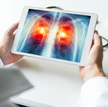 Nowe metody leczenia raka płuca – rosną szanse medycyny w walce z tym nowotworem