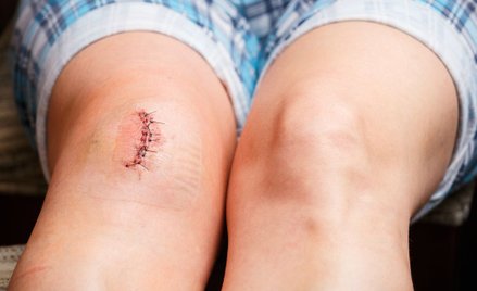 Skąd się biorą blizny i dlaczego nie wolno ich opalać?