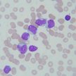 Zmodyfikowane komórki walczą z białaczką