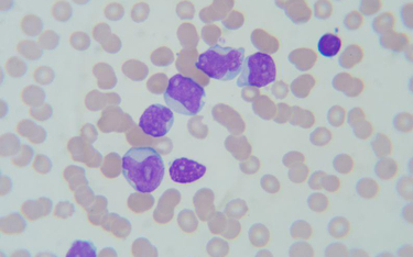 Zmodyfikowane komórki walczą z białaczką