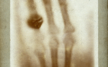 Pierwsze zdjęcie rentgenowskie zrobione przez niemieckiego uczonego Wilhelma Roentgena, przedstawiaj