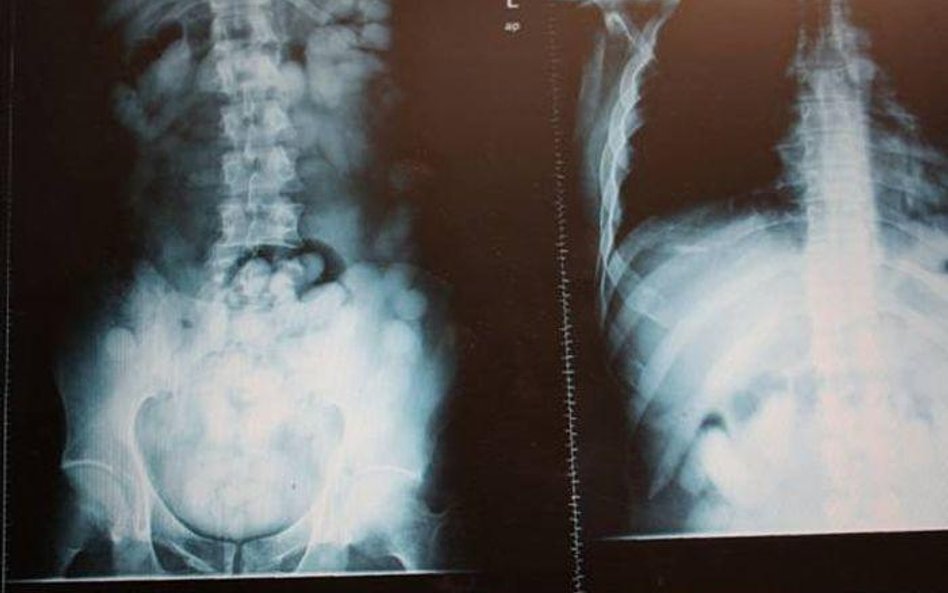 Dwa kilogramy kokainy w żołądkach